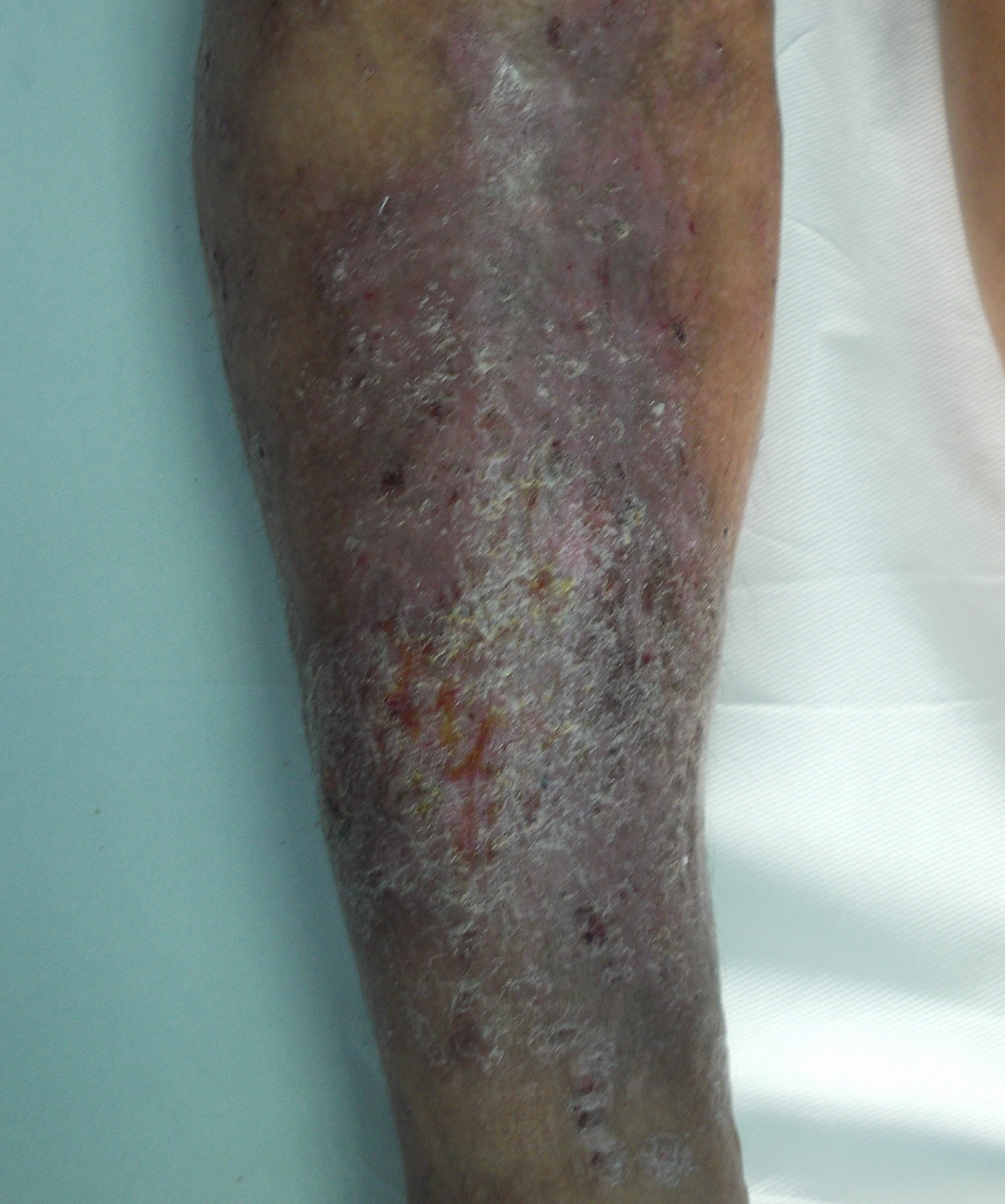 Vene varicoase pe picioare simptome și tratament la domiciliu - Tratamentul simptomelor varicoase