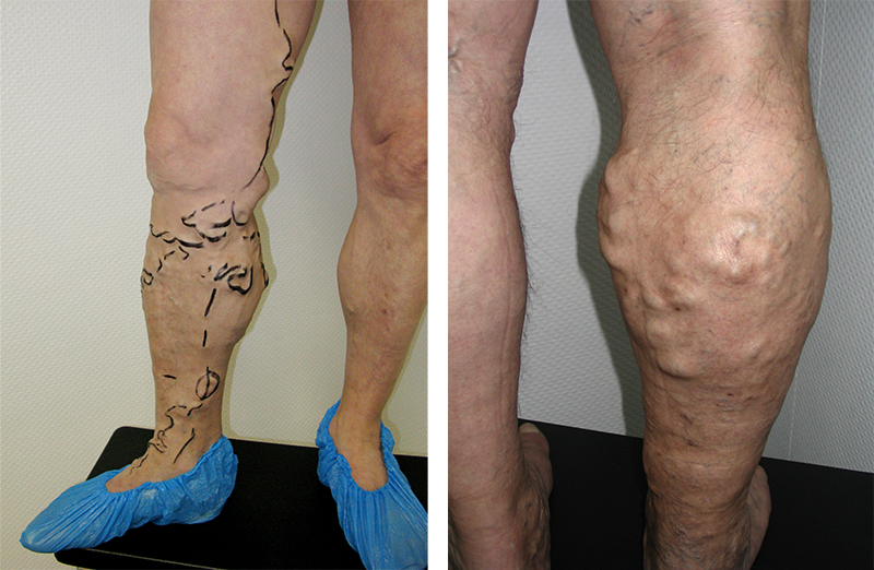 Varicoza burta Varice la nivelul picioarelor la bărbați: cauze, simptome, tratament