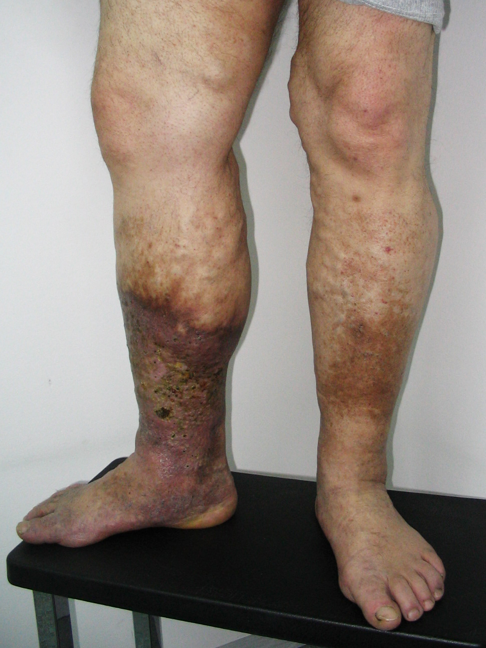 tratamentul cu picioarele varicoase începator varicoza pe picioare la femei