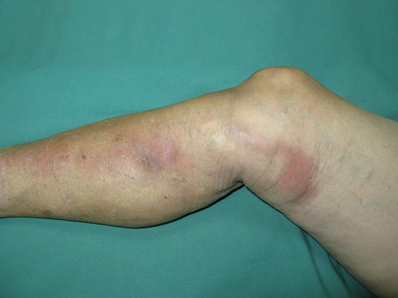 de ce picioarele se zgârie în varicoza varicoza i hepatita